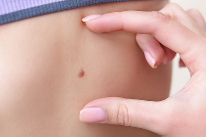 Melanoma: con l'immunoterapia si evita la recidiva