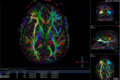 La dipendenza da alcol, alle volte, è questione di neuroni