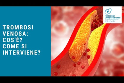 Che cos'è la trombosi venosa profonda?